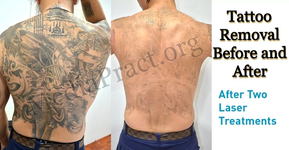 5. How to Prepare for Tattoo Removal