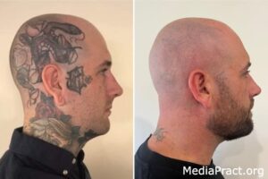 Tattoo Removal Before and After