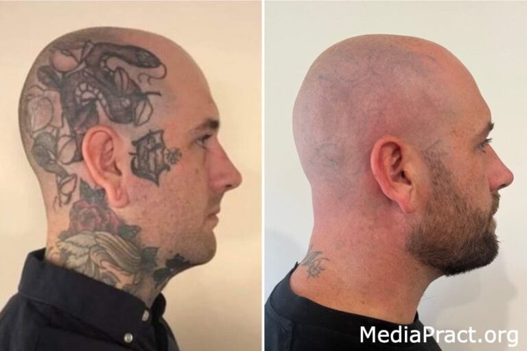 Tattoo Removal Before and After: What You Need to Know