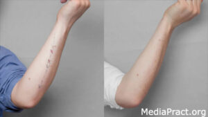 Tattoo Removal Before and After: Key Expectations