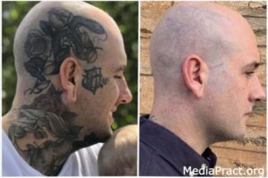 Tattoo Removal Before and After Pictures: Setting Expectations